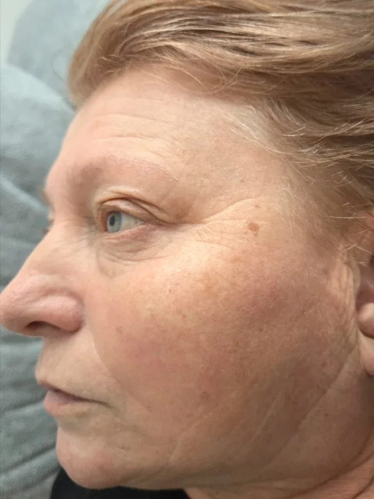 Haut nach der Anti-Aging Behandlung — Lady Vi Koblenz und Bad Ems