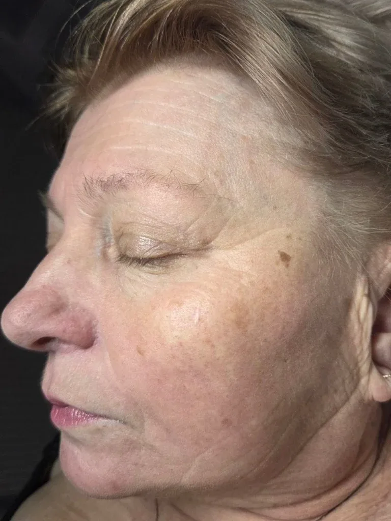 Haut vor der Anti-Aging Behandlung — Lady Vi Koblenz und Bad Ems