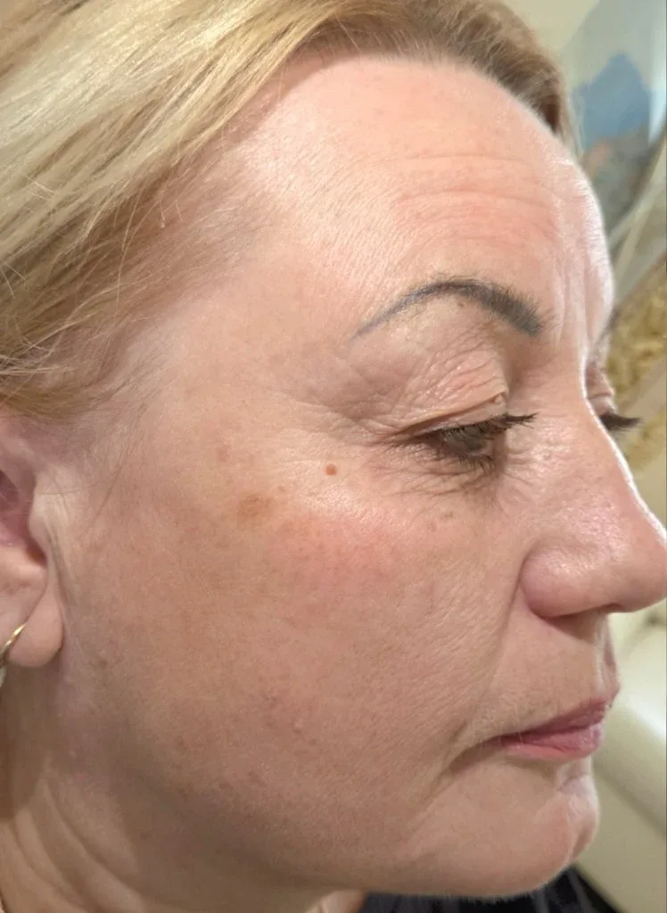 Haut ein Monat nach Microneedling — Lady Vi Koblenz und Bad Ems
