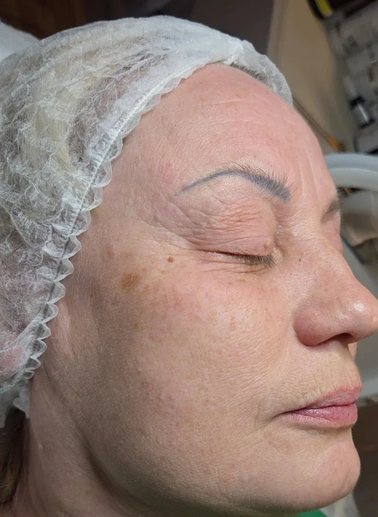 Haut vor dem Microneedling — Lady Vi Koblenz und Bad Ems