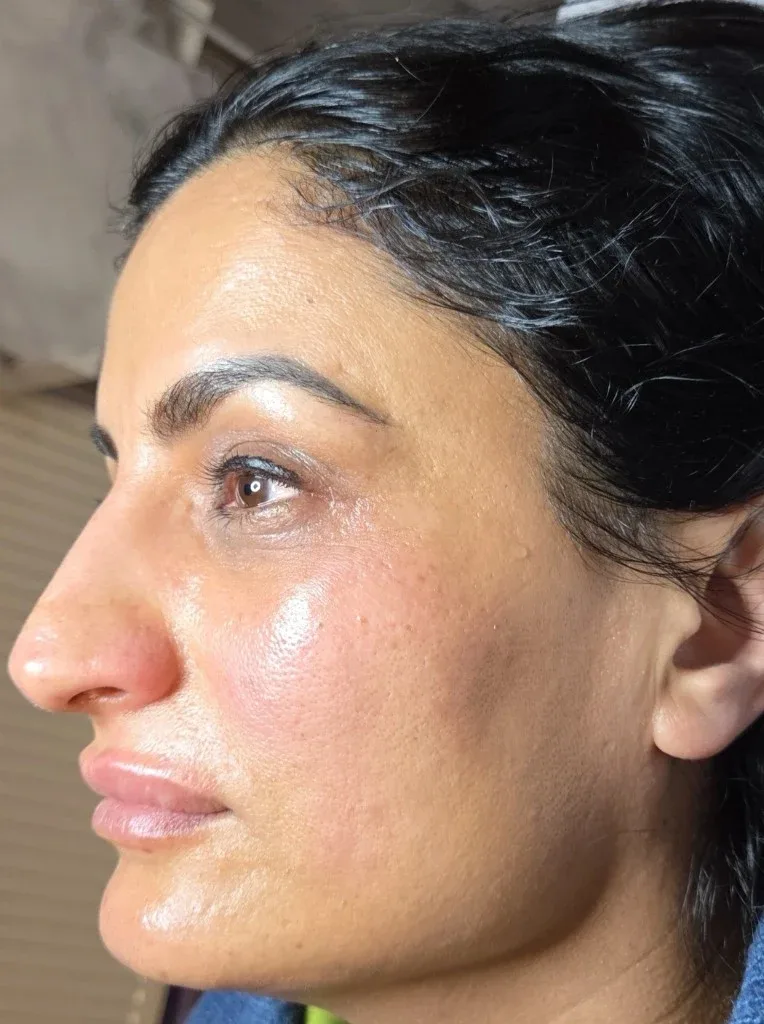 Haut zwei Wochen nach dem Peeling — Lady Vi Koblenz und Bad Ems