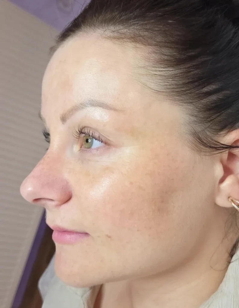 Haut zwei Wochen nach der Aufhellungsbehandlung — Lady Vi